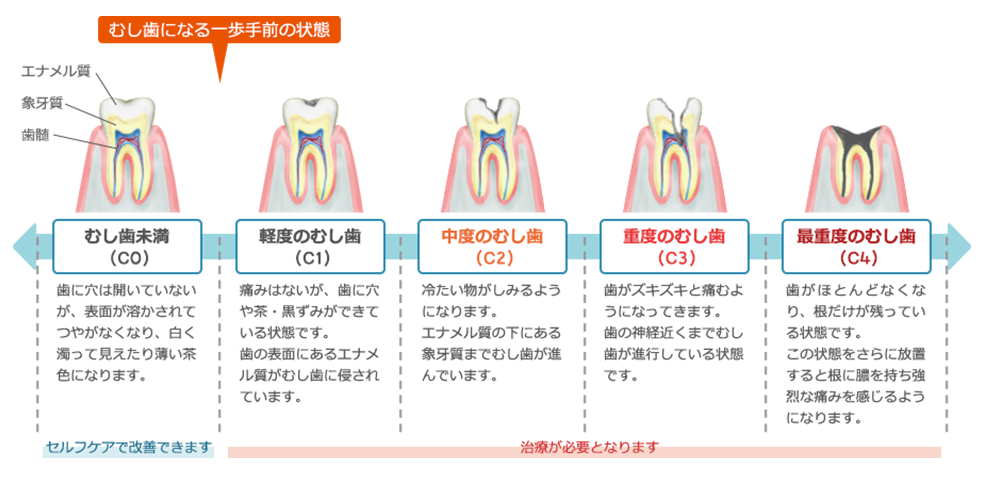 むし歯の症状と進行の様子