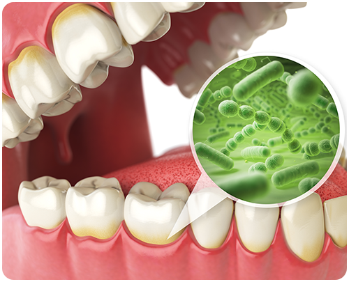 35歳以上の約80％が歯周病