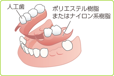 ノンクラスプ