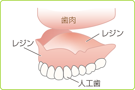 レジン床総入れ歯