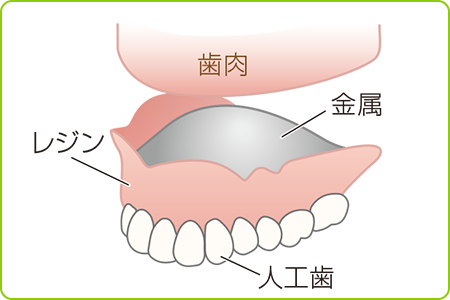 金属床入れ歯