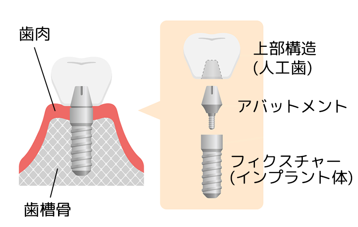 インプラントとは？