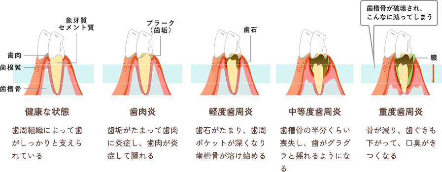 歯周病の進行