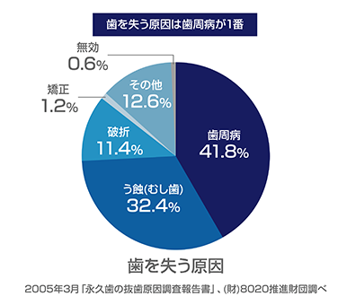 歯周病は永久歯を失う理由第1位