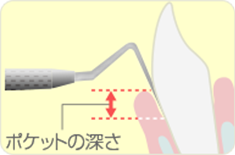 プローブを用いた検査